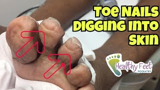 Nails Curling Into Toes  Nail Trimming for Diabetic Ingrown Nails at the Ends of the Toe [upl. by Eiboj]