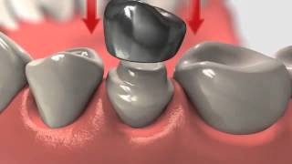 Dental Crown  Crowns And Root Canal Treatment [upl. by Tertias301]