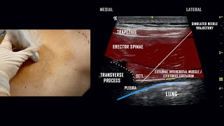 Paravertebral Block  UltrasoundGuided Demonstration [upl. by Garling]