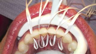 Retanium Splint Placement Orthodontics [upl. by Marje]