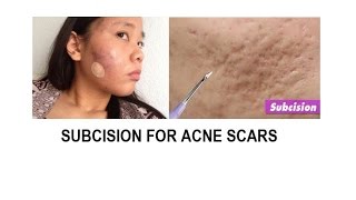 Acne scar treatment Subcision and TCA cross [upl. by Aliehs399]