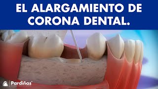 Alargamiento de corona dental © [upl. by Colner]