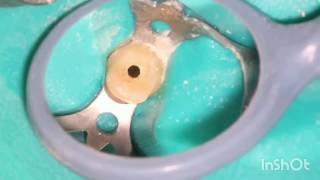 Root canal treatment full step by step [upl. by Terej]