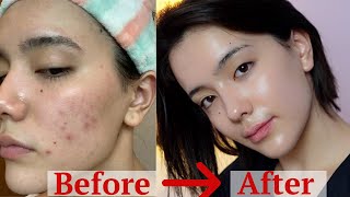 how I got rid of my ACNE after 8 years  ONLY thing worked [upl. by Paolina341]