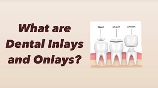 What are Dental Inlays and Onlays [upl. by Ybab200]