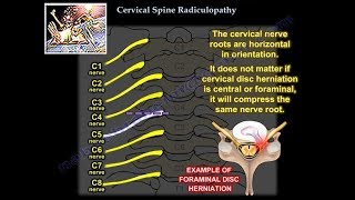 Spurling Test Positive Results Explained [upl. by Yltnerb]