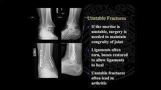 Ankle Replacement and Ankle Fusion Surgery and Recovery [upl. by Tavis]