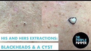 His and Hers Extractions Blackheads amp A Cyst [upl. by Nyllewell]