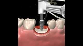 Step by step dental implant surgery Gary R OBrien DDS [upl. by Lewiss]