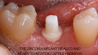 Zirconia Implant [upl. by Rowney]