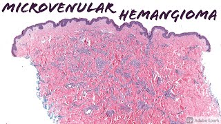 Microvenular Hemangioma 5Minute Pathology Pearls [upl. by Hogan76]