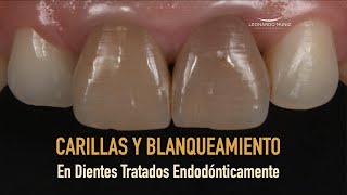 Carillas y blanqueamiento en dientes tratados endodónticamente [upl. by Chloette]