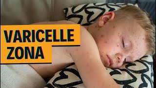 VARICELLE  ZONA  1 seul virus  2 maladies [upl. by Letha]