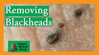 Several Blackheads  Auburn Medical Group [upl. by Llerruj]