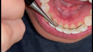 “POST BRACES” Fixing Bonded Retainer [upl. by Nick]