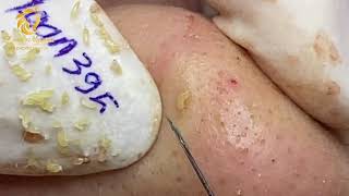 Treatment of blackheads and whiteheads 395  Loan Nguyen [upl. by Jaycee]