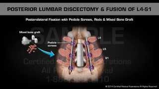 Posterior Lumbar Discectomy amp Fusion of L4S1 [upl. by Ogden]