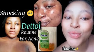 How To Use DETTOL Antiseptic Liquid To Clear Acne amp PimplesDettol For Hyperpigmentations•sideeffect [upl. by Enogitna]