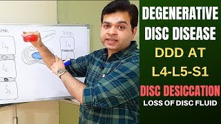 Degenerative Disc Disease DDD L4 L5 L5 S1Disc Desiccation Disc Degeneration Disease Treatment [upl. by Nwahsauq613]