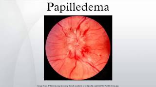 Papilledema [upl. by Aisanat]