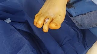 Surgical Correction of Hammertoe deformity [upl. by Broddie]