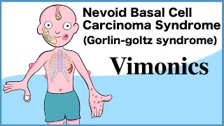 Nevoid Basal Cell Carcinoma Syndrome Gorlingoltz syndrome Visual mnemonics [upl. by Georgette391]