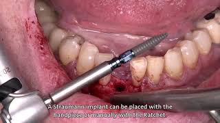 Dr Stefan P Hicklin Straumann® BLT Ø 29 mm implant [upl. by Alvita82]