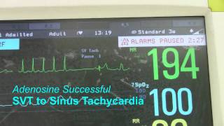 SVT or Supraventricular Tachycardia [upl. by Godden]