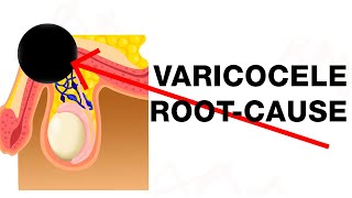 Varicocele Treat the RootCause [upl. by Childs]