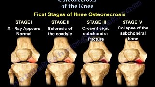 Osteonecrosis Of The Knee  Everything You Need To Know  Dr Nabil Ebraheim [upl. by Luckin]