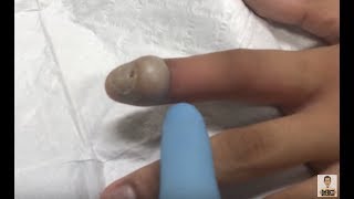 large infected bump on finger [upl. by Melc]