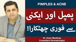 How To Remove Pimples Overnight  Acne Treatment  Pimple Khatam Karne Ka Tarika [upl. by Adella]