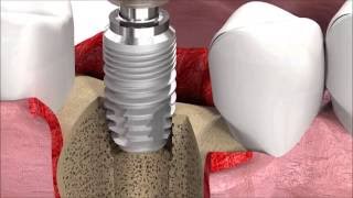 SIC invent Dental Implant Procedure SICmax implant insertion [upl. by Box]