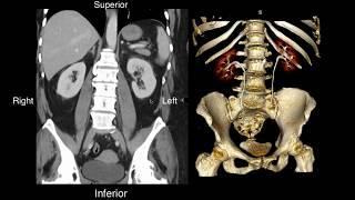 Normal Renal Anatomy [upl. by Gretta]