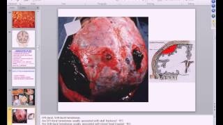 Medical School Pathology 2013 Season Session 6 Hemodynamic Disorders I [upl. by Eicirtap747]