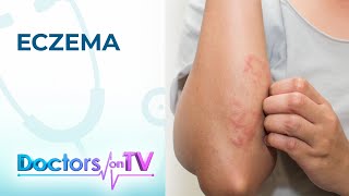 Eczema Symptoms Causes and Treatment  Doctors on TV [upl. by Seiter]