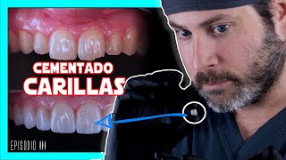 👉COMO se ponen las 𝘾𝘼𝙍𝙄𝙇𝙇𝘼𝙎 𝙙𝙚 𝙋𝙊𝙍𝘾𝙀𝙇𝘼𝙉𝘼 en los dientes Te lo explico FÁCIL  COMPRUEBALO✅ [upl. by Ativak]