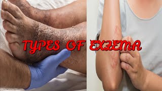 7 TYPES OF ECZEMA YOU NEED TO KNOW [upl. by Sachsse]