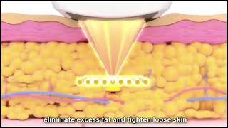 Liposonix Patient Video [upl. by Dal]