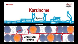 Krebsarten  Karzinome Sarkome etc [upl. by Nnylatsyrc272]