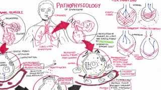 Emphysema  Pathophysiology COPD [upl. by Hairu]