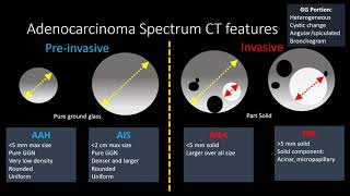 Mucinous Cystadenoma Ultrasound [upl. by Burne]