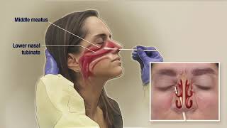 Medical  Huge Booger Inside Nose Removal Medical [upl. by Ynohtnanhoj375]