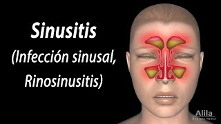 Sinusitis Animación Alila Medical Media Español [upl. by Atkinson]