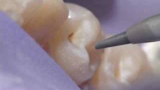 Dental Air Abrasion  Denville NJ [upl. by Iliam]