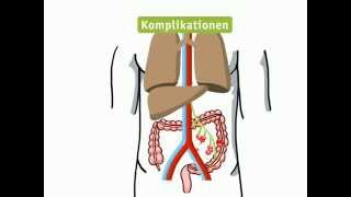 Kolonkarzinom  Lehrvideo [upl. by Susana514]