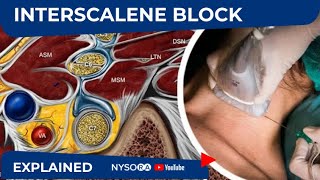 NYSORA Regional Anesthesia Interscalene Block [upl. by Oiratnom]