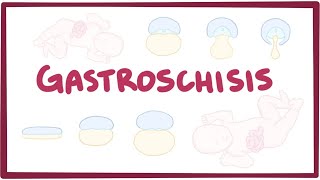 Gastroschisis  What is gastroschisis [upl. by Wallinga168]