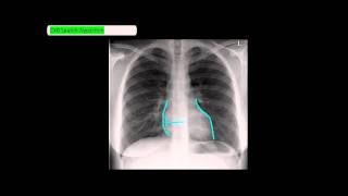 Chest XRay Reading Method  ABCDE UndergroundMed [upl. by Sille]