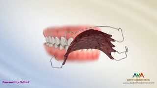 Orthodontic Retainers Hawley Clear and Permanent [upl. by Sandi958]